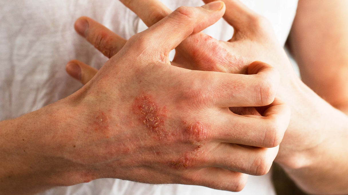 Natural ways to prevent and treat Eczema