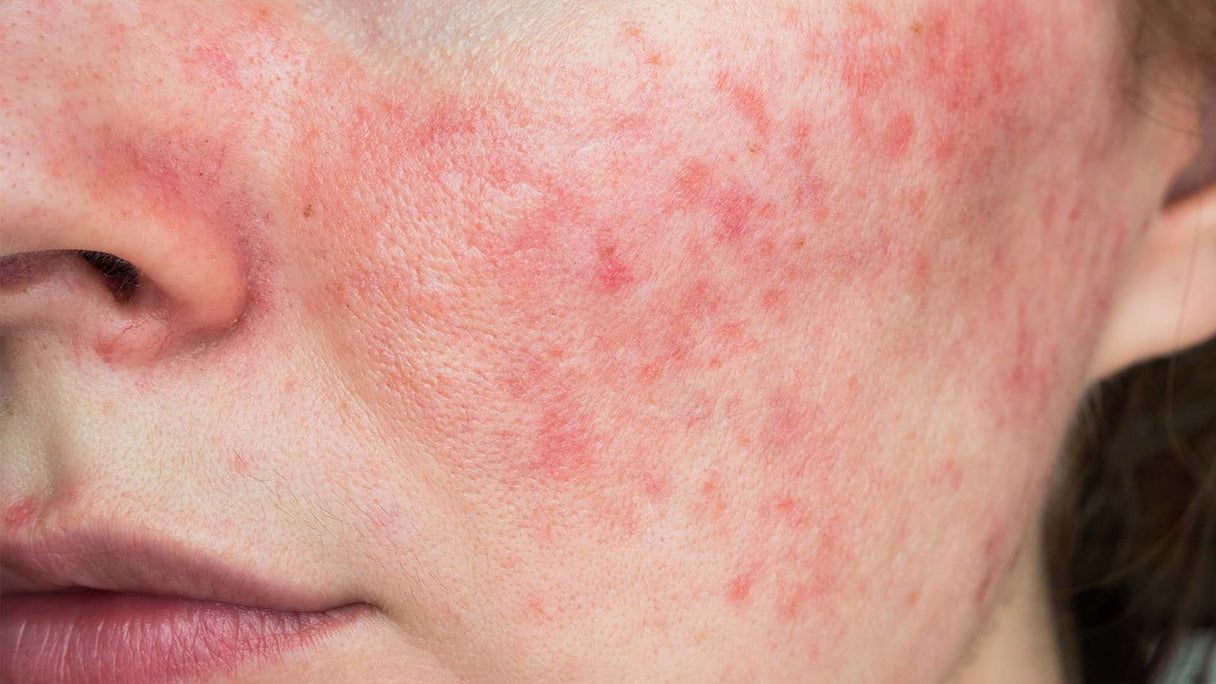 5 Natural remedies to treat rosacea